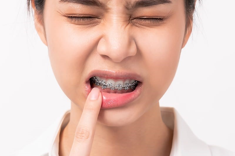 Broken brackets and braces pain happen. See an orthodontist to help relieve your issues.