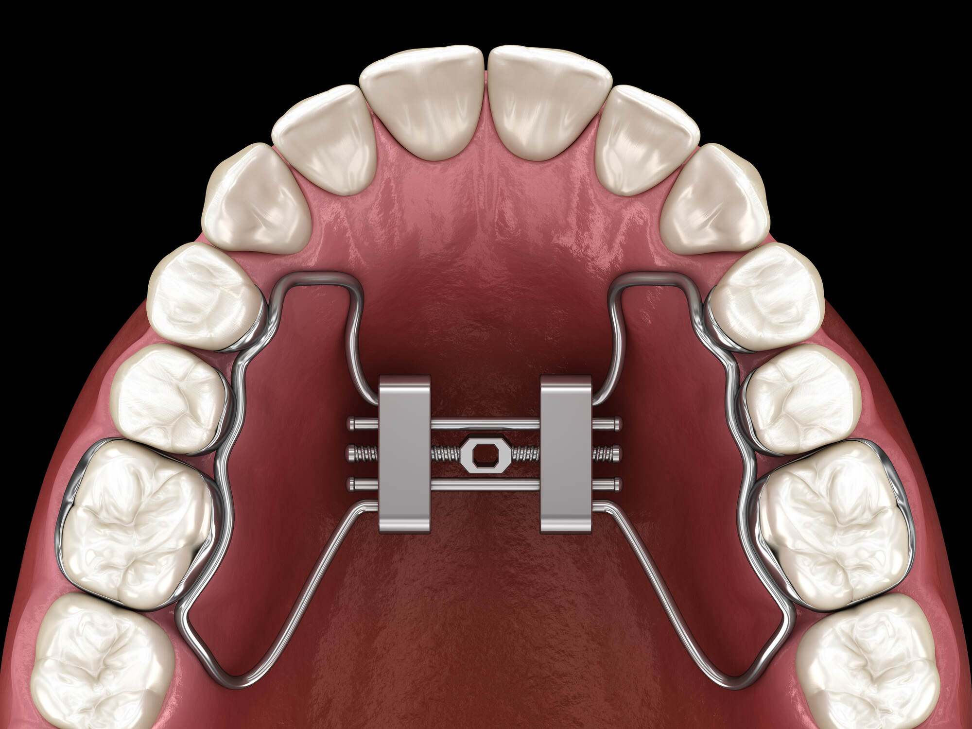 A palatal expander, a dental device used to correct malocclusions such as crossbites and crowding by widening the upper jaw.