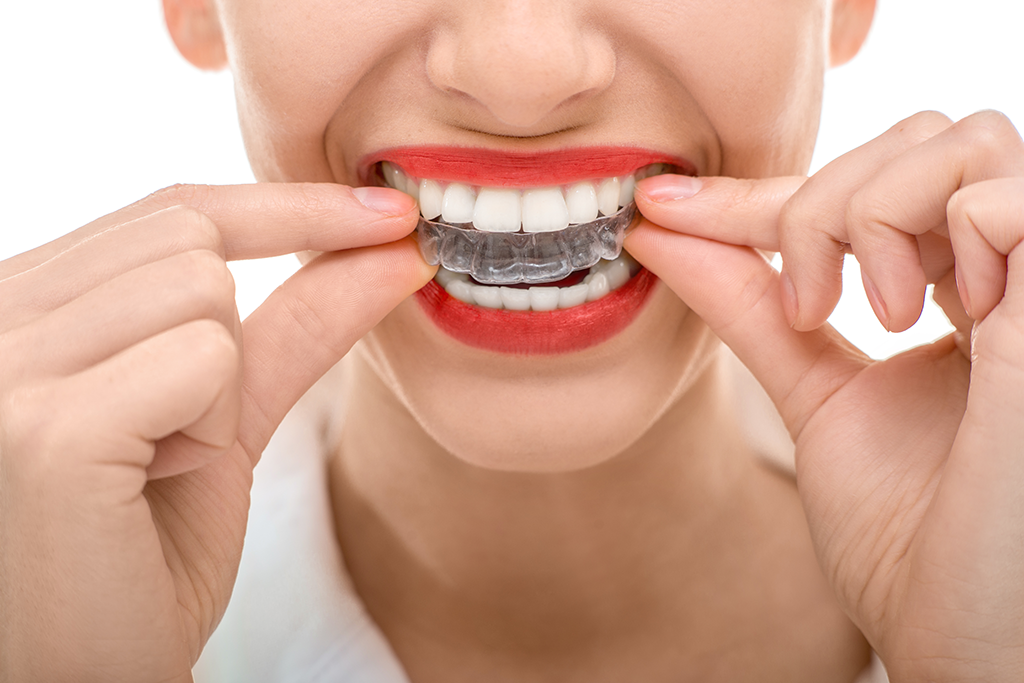 Woman starting treatment with clear aligners.