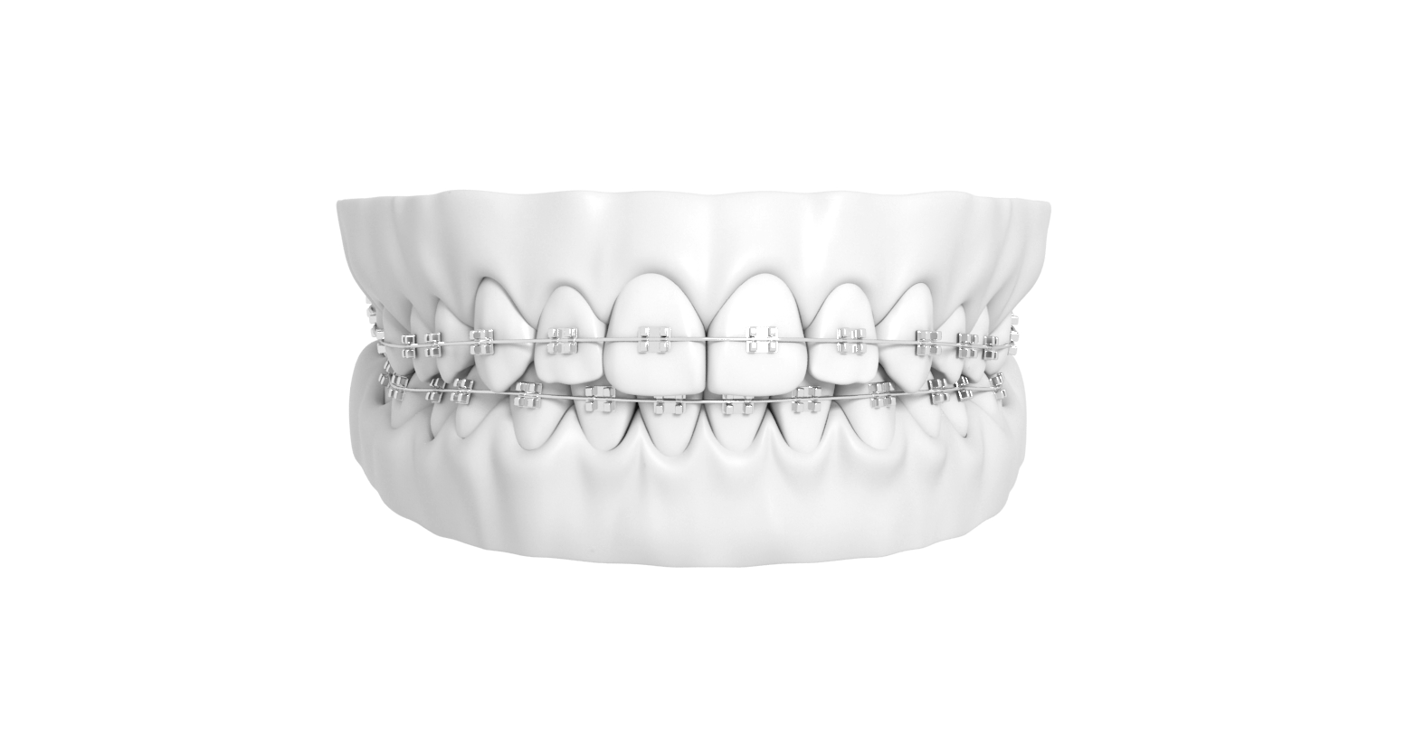 White 3D image of teeth with a full set of metal braces.